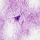 stem cell therapy